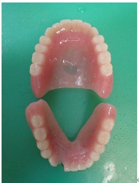 最低限必要な機能を有した義歯の製作についての考察 その2・全部床義歯