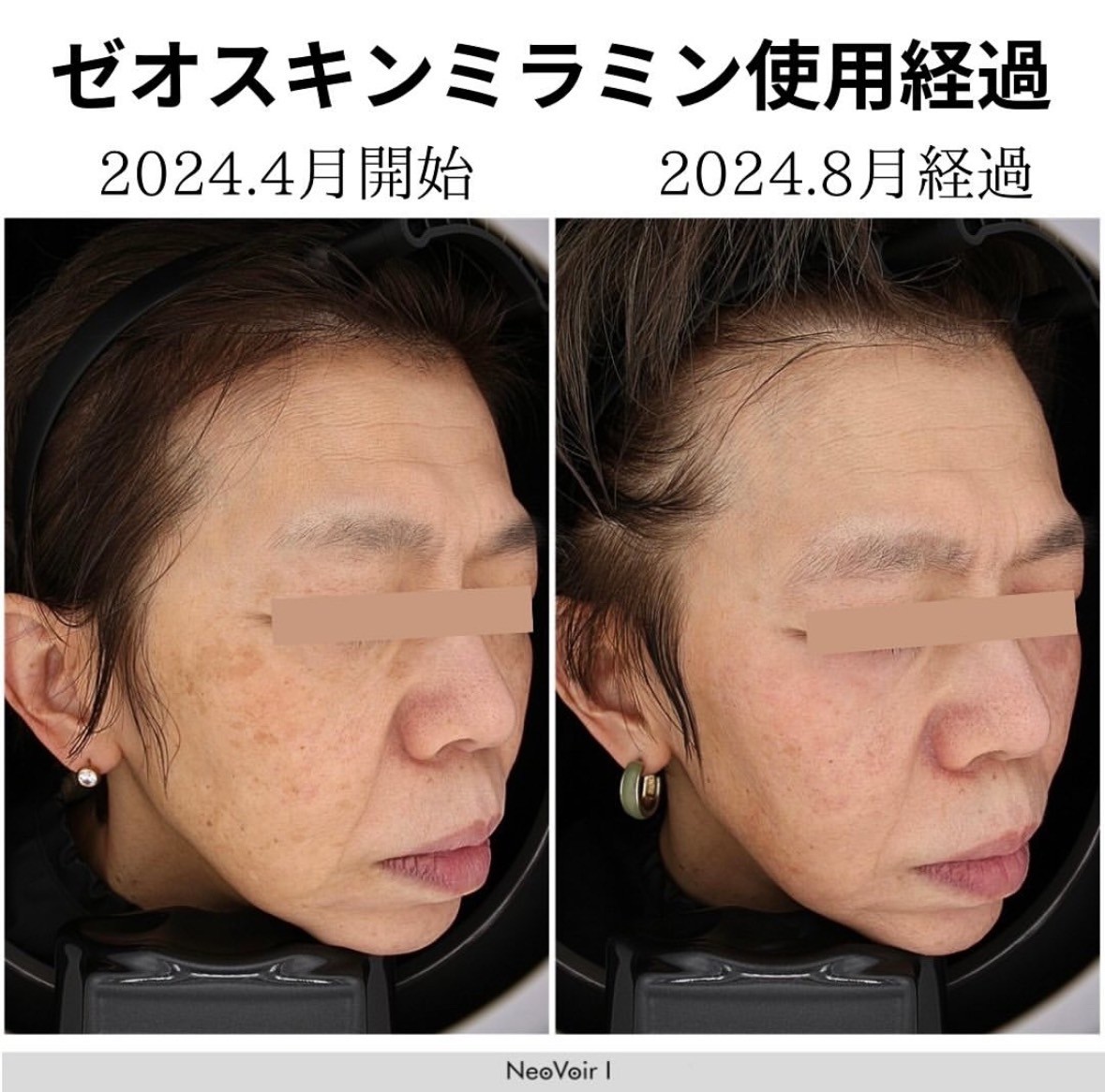 ゼオスキン マイルドコース | 奈良県の美容皮膚科ならノアクリニック