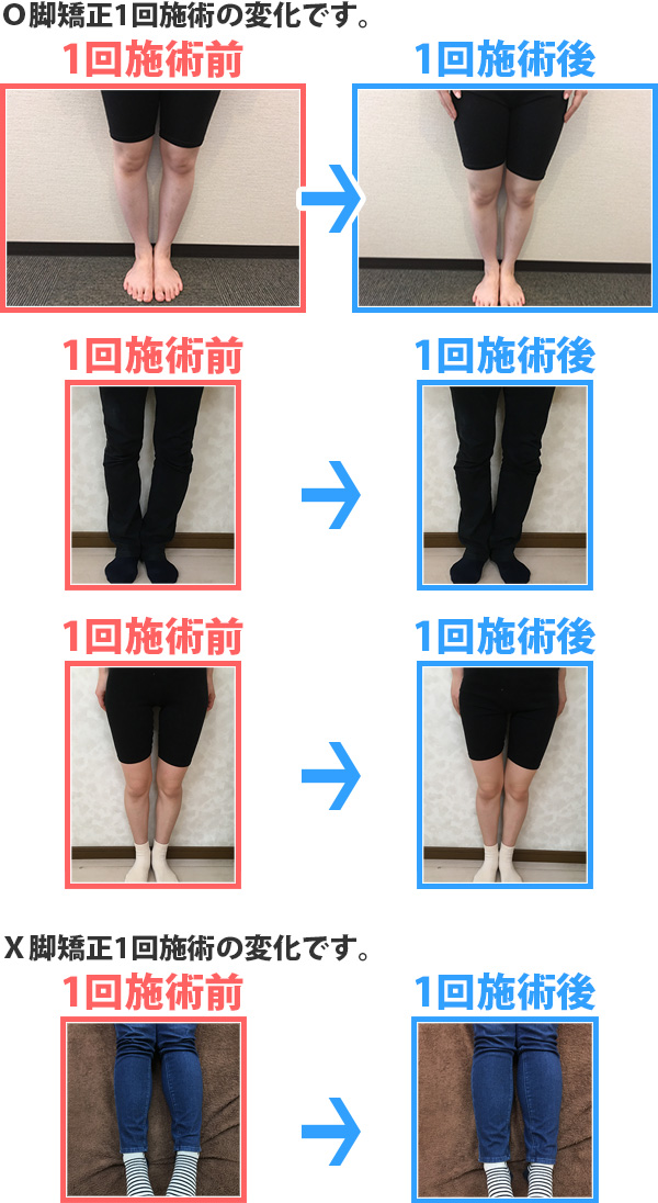 O脚・X脚矯正 | 岡山県真庭市の【おおにし整体院】