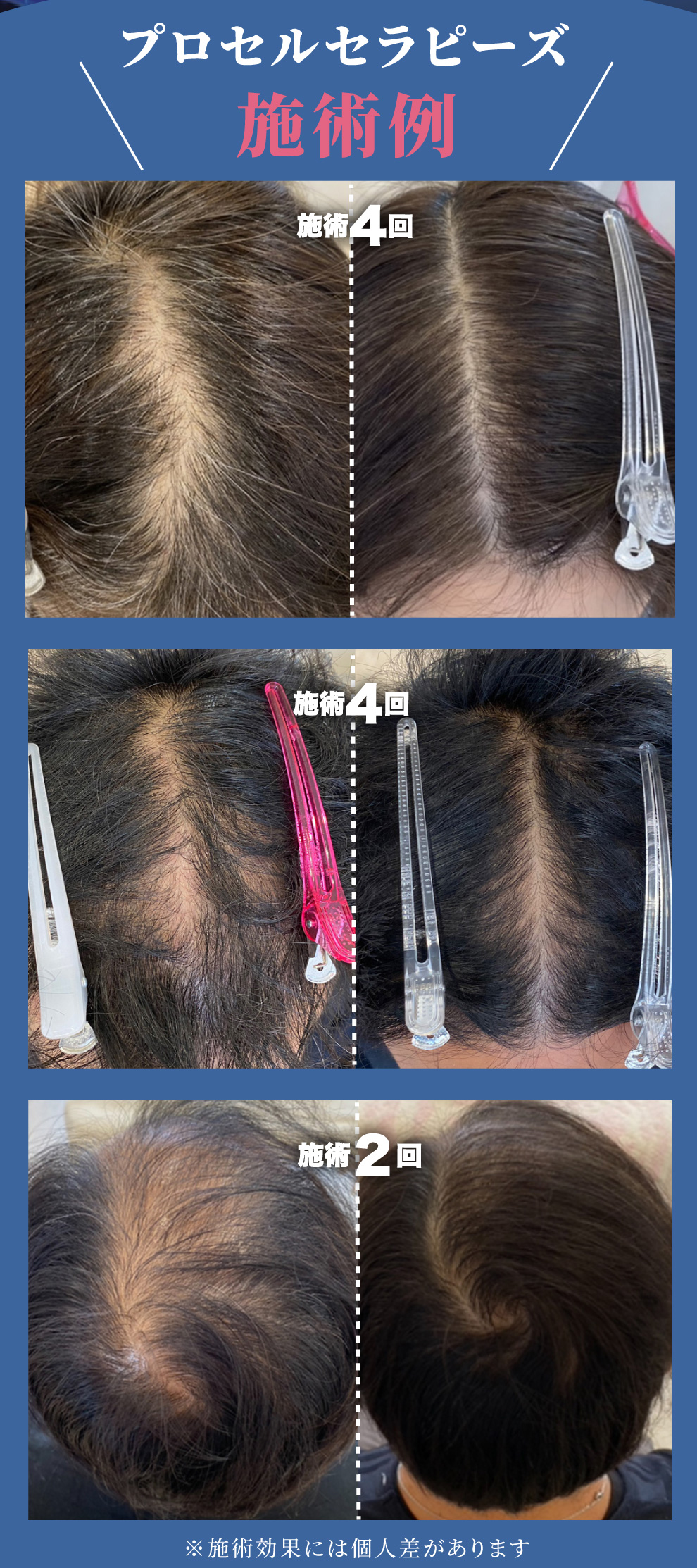 プロセルセラピーズ 頭皮をスピード改善し驚くほど元気にします