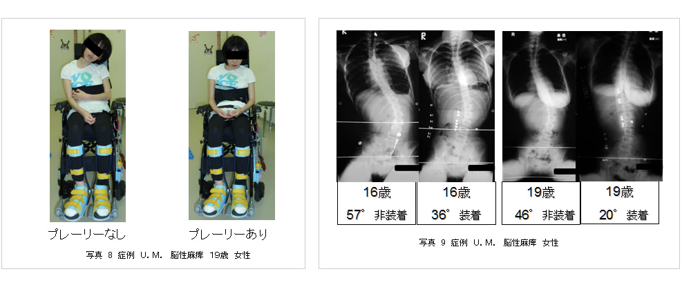 医療に従事する方へ | 医療用装具側弯矯正装具プレーリーくん | 社会
