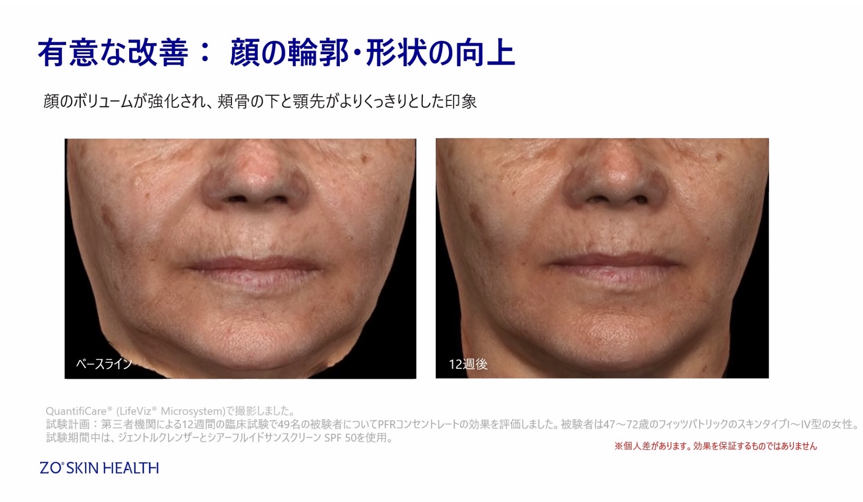 新発売キャンペーン☆PFRコンセントレート〜シワ・たるみの注入治療を