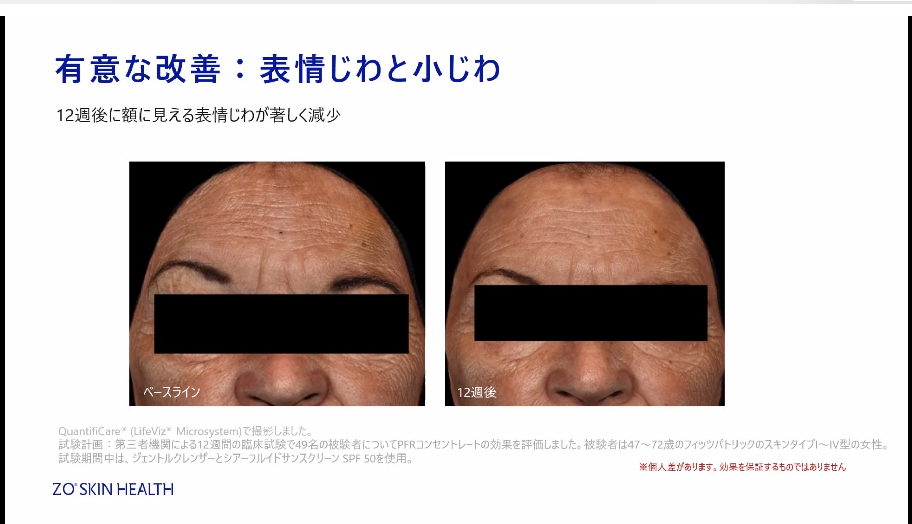 新発売キャンペーン☆PFRコンセントレート〜シワ・たるみの注入治療を