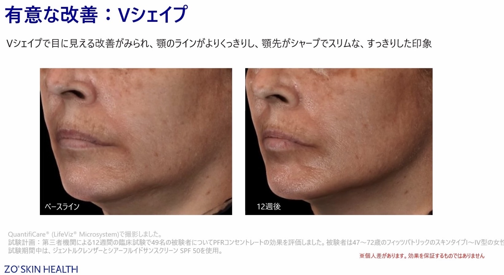 新発売キャンペーン☆PFRコンセントレート〜シワ・たるみの注入治療を