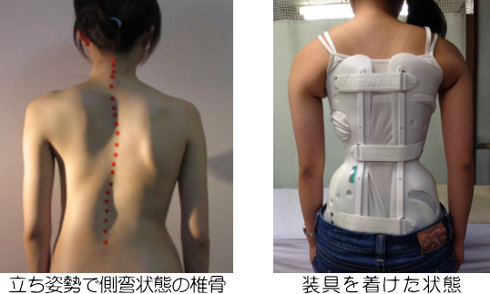 脊柱側弯症 | 大仙市大曲の整体は龍観堂