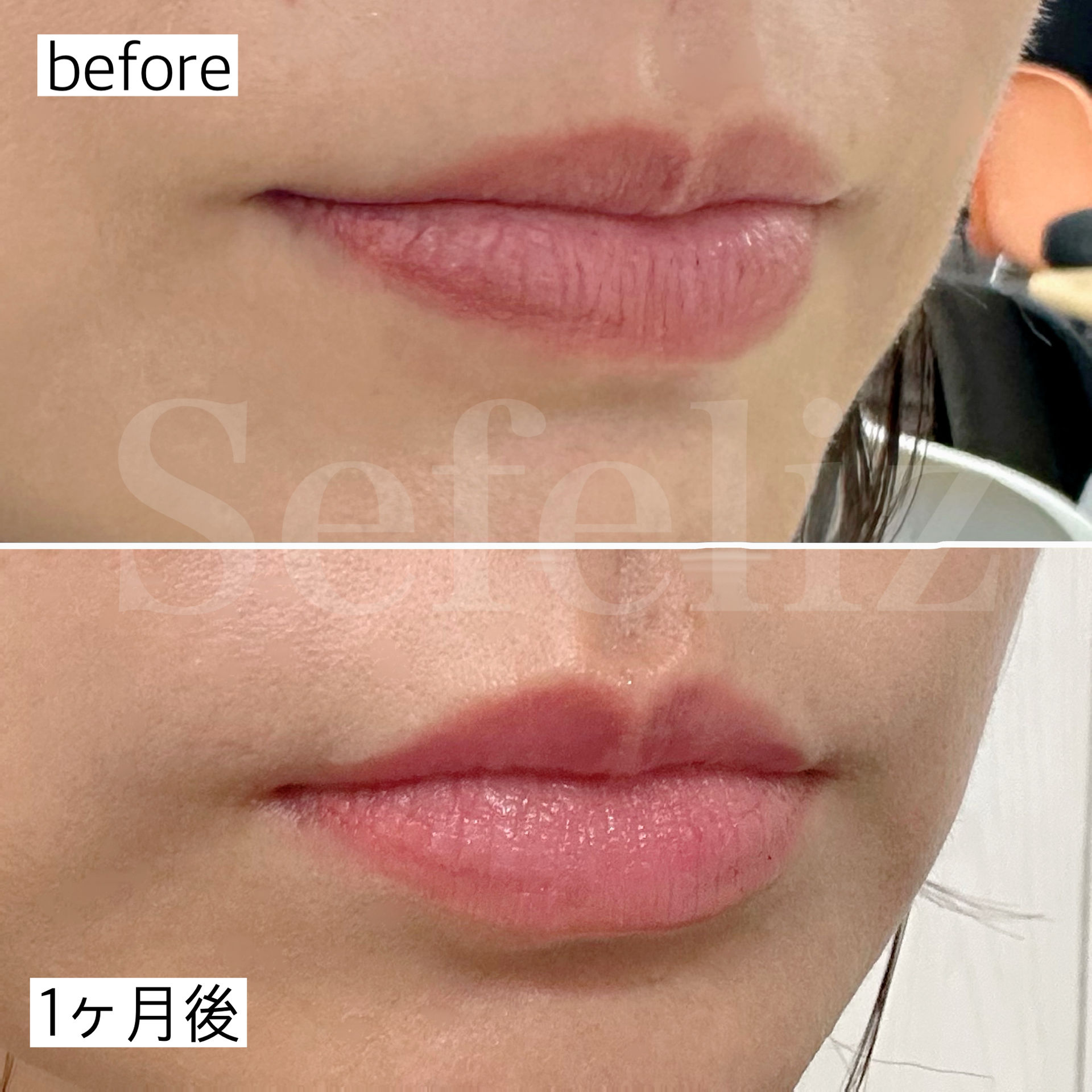 ローマピンク唇｜施術1回でここまで変化！実際の症例をご紹介