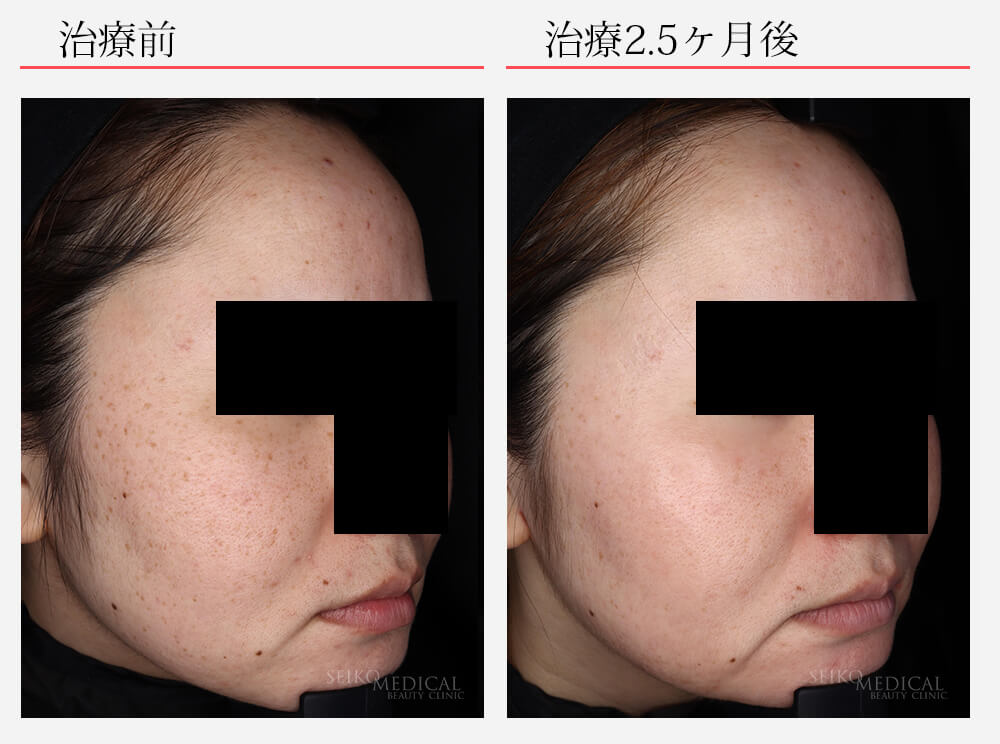 ニキビを悪化させずにセラピューティック | ゼオスキンヘルス｜セイコ