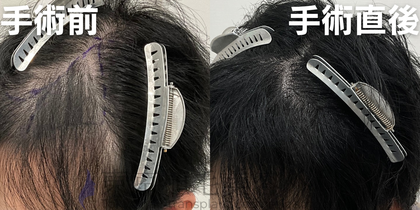 ✓30代 男性 ✓FUE1500株 ✓前頭部・頭頂の手術 ✓手術7ヶ月後 | 症例