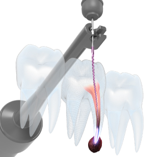 歯の神経の治療】新発売の機器ルートZX3を導入しました【高蔵寺