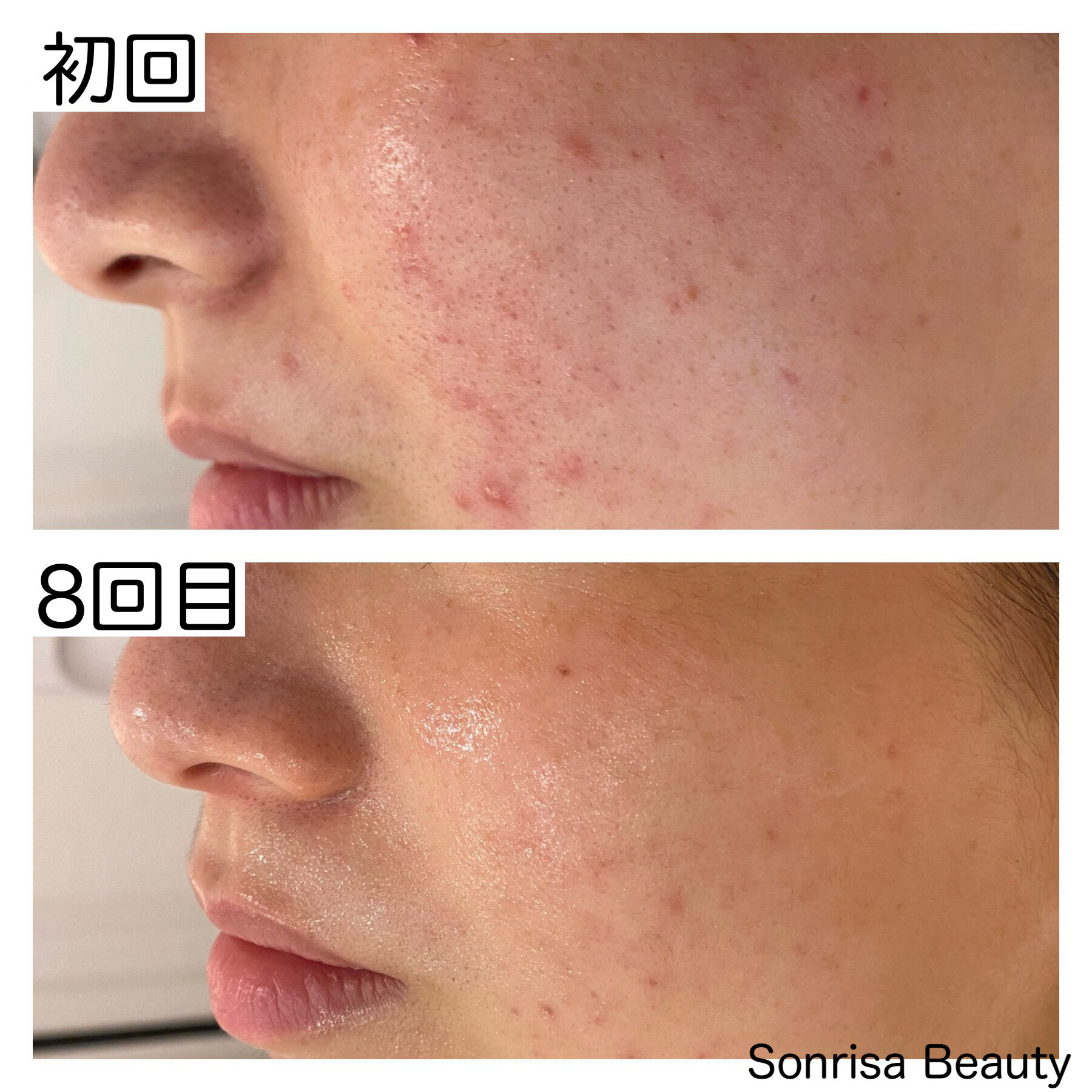 フェイシャル・ハーブピーリング 剥離ありと剥離なしの違いは