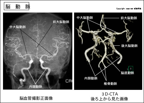 Neuroinfo Japan：脳の動脈