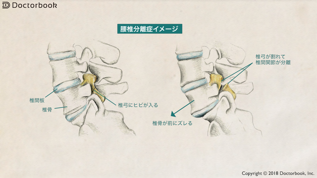 医師出演】腰椎分離症とは ー スポーツに打ち込む10代に向けて