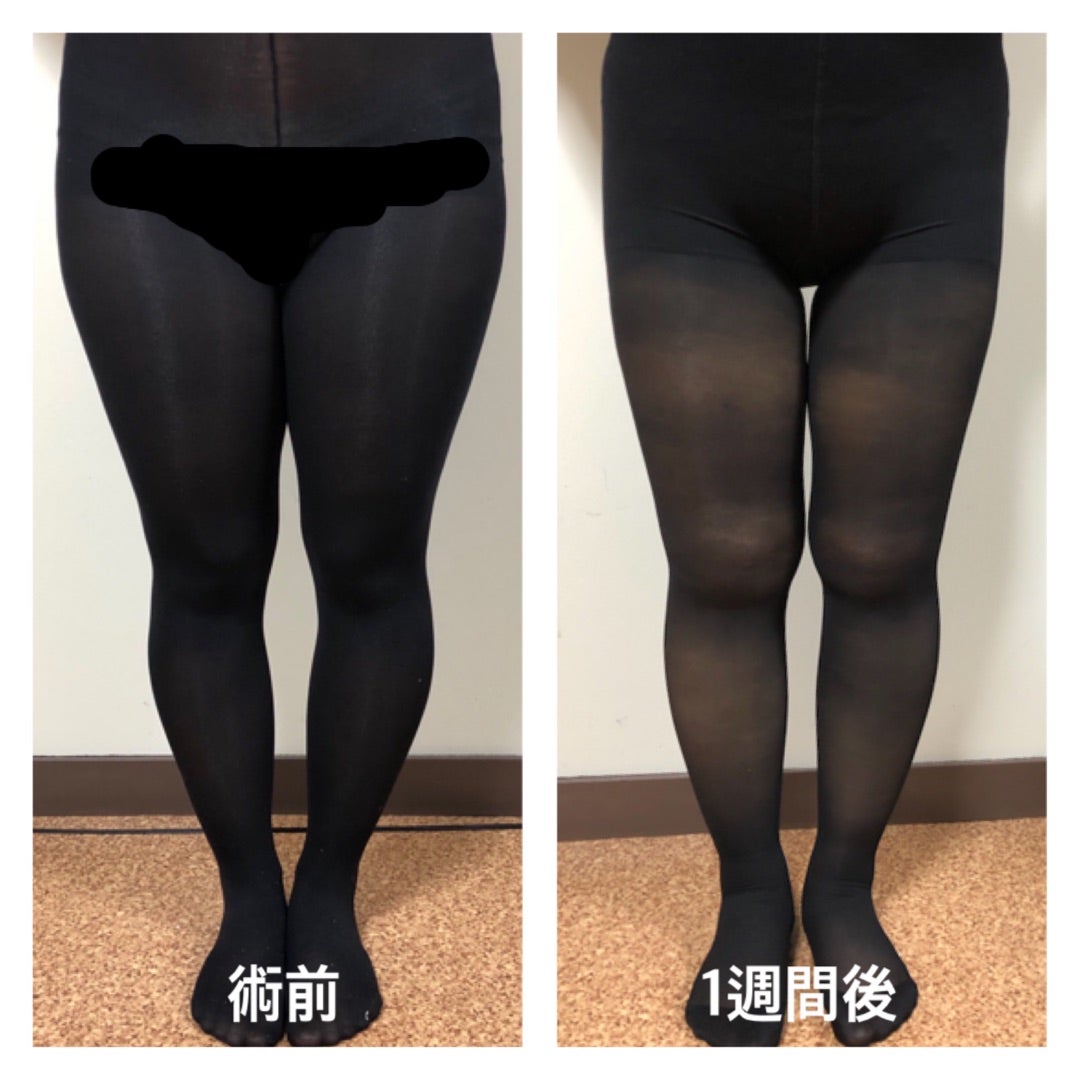 スタッフ脂肪吸引【7日目】 | 湘南美容クリニック川崎院スタッフのブログ