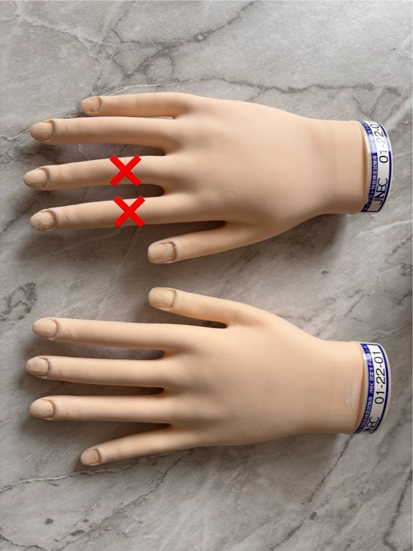 認定ハンド 両手 右手骨折2本有り