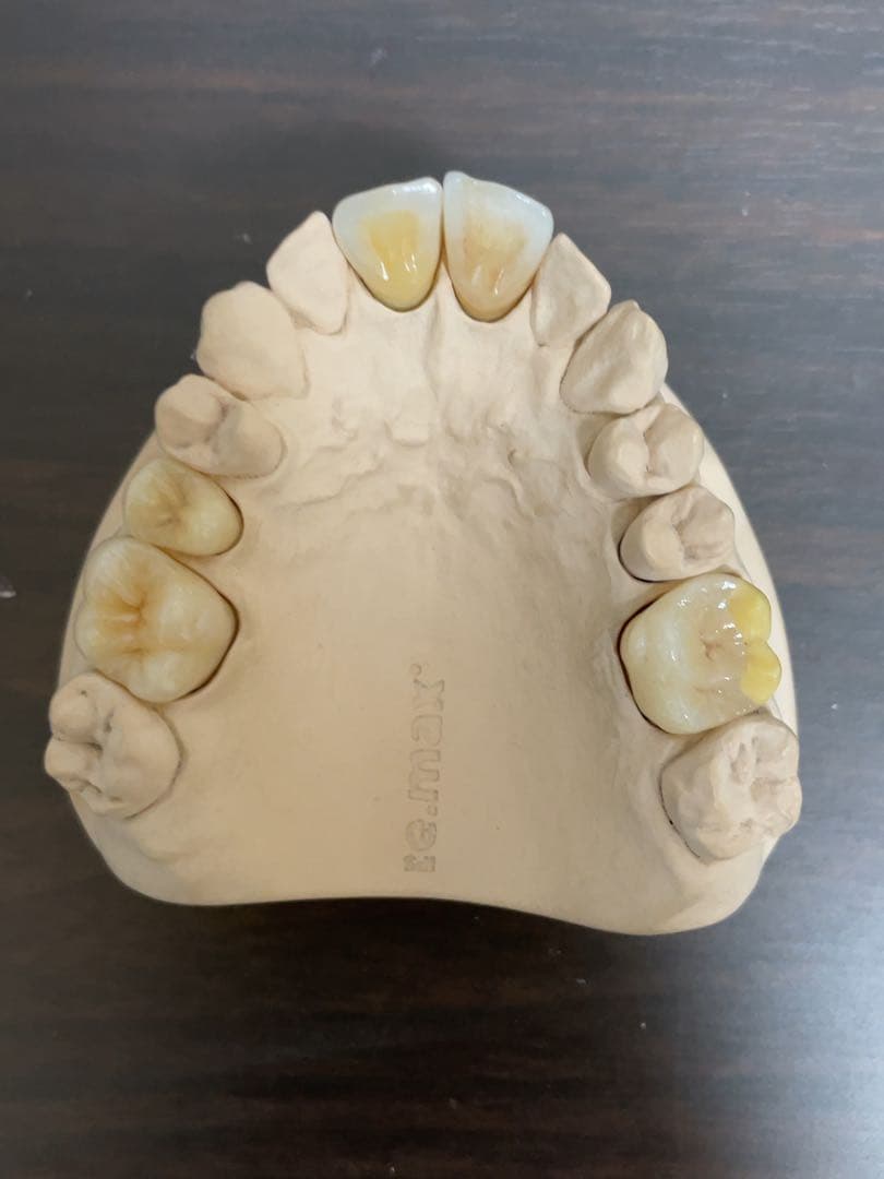 歯科技工　イーマックスサンプル模型　65116 歯科医院などのサンプルに！