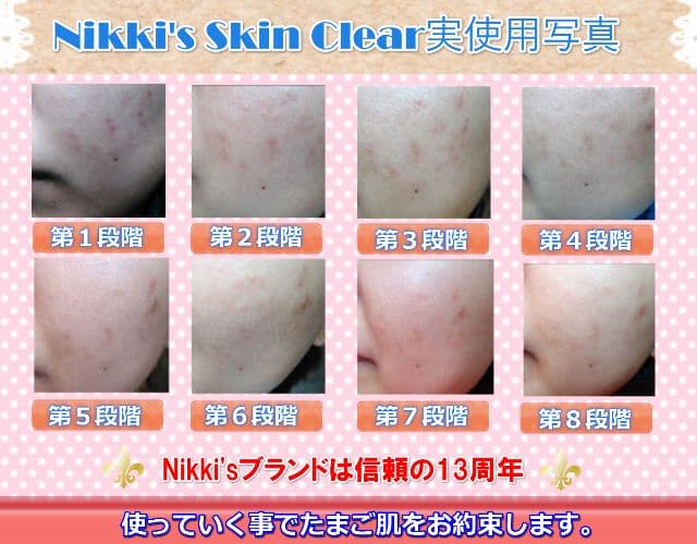 しみ、そばかす、ニキビ跡、毛穴　噂のNikki's Skin Clear　通常版